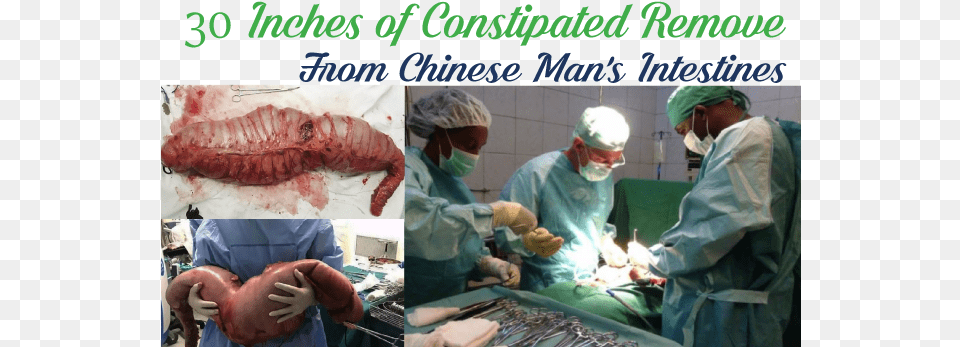 Inches Of Constipated Remove From Chinese Man39s Does The Intestines Look With Constipation, Indoors, Medical Procedure, Hospital, Operating Theatre Png Image