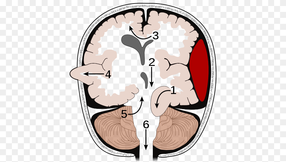 Increased Intracranial Pressure, Ct Scan, Baby, Person, Heart Free Png Download