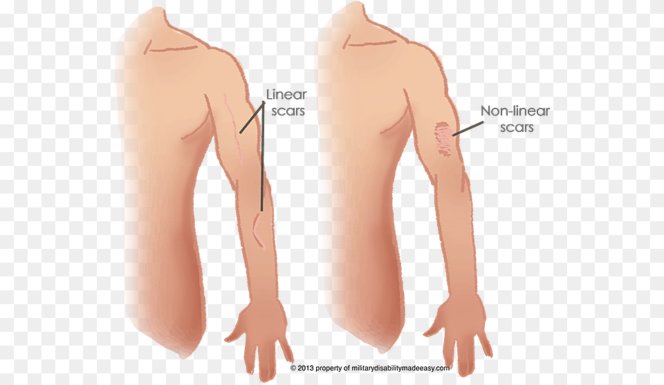 Index Of Scars, Arm, Body Part, Person, Chart Free Png Download