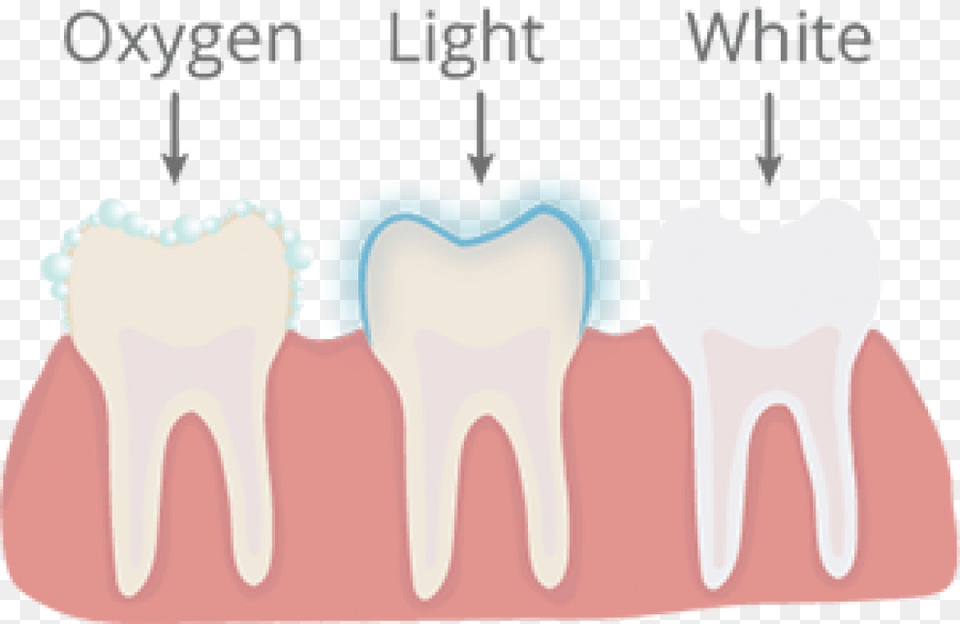 Inlay Onlay Crown, Body Part, Mouth, Person, Teeth Free Transparent Png