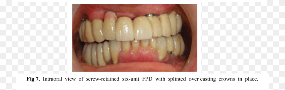 Intraoral View Of Six Unit Screw Retained Fpd Without Science, Body Part, Mouth, Person, Teeth Free Png