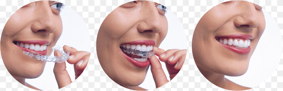 Invisalign Invisalign Braces In Dubai, Adult, Teeth, Person, Mouth Png Image
