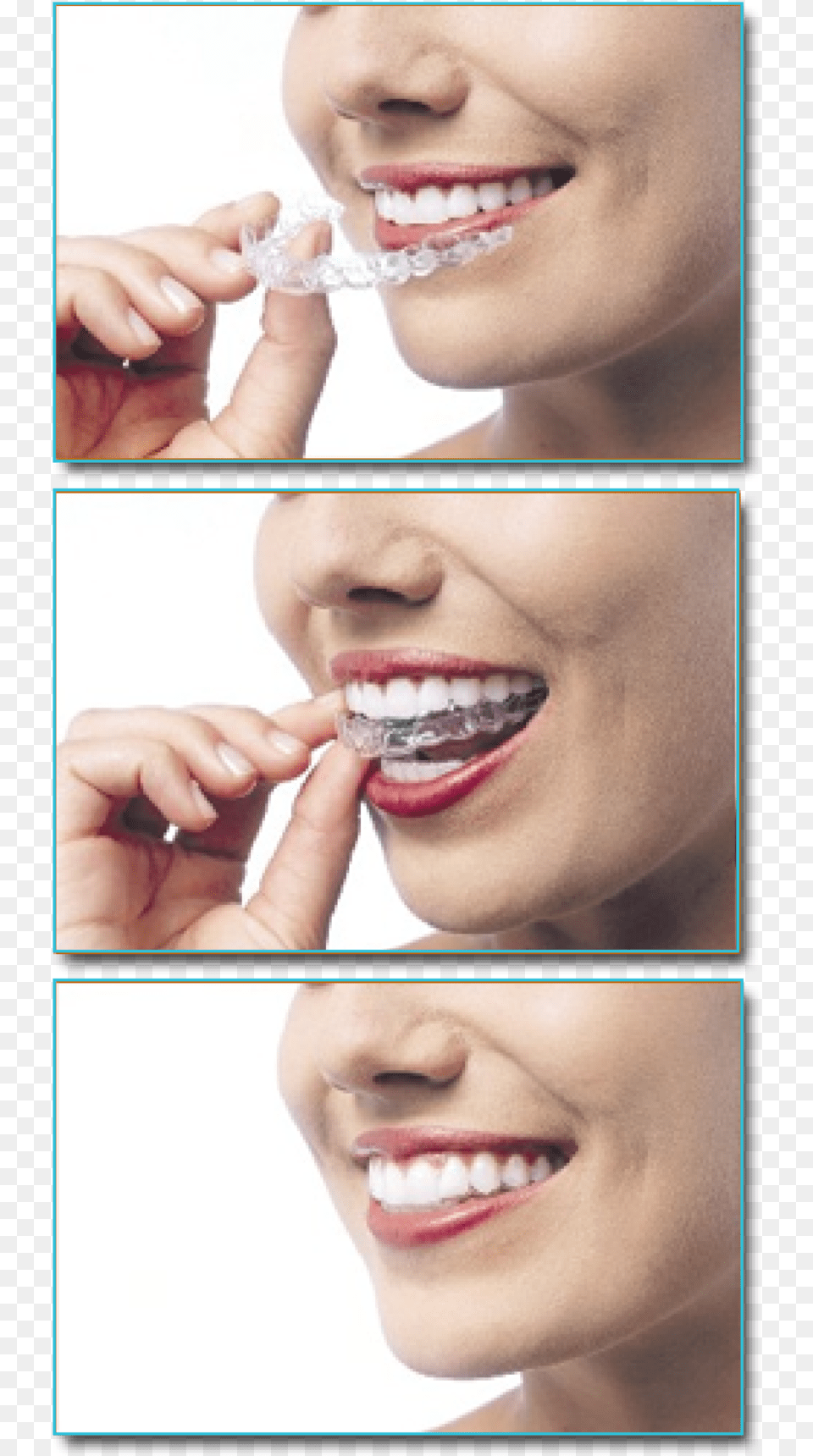 Invisalign Someone With Clear Aligners, Teeth, Body Part, Person, Mouth Free Png Download