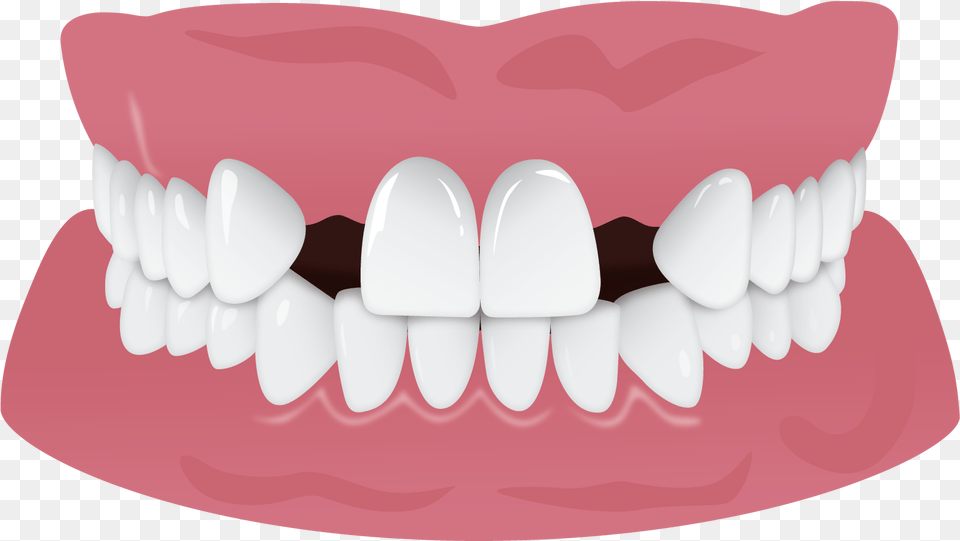 Ipr Black Triangles Results, Body Part, Mouth, Person, Teeth Free Png Download