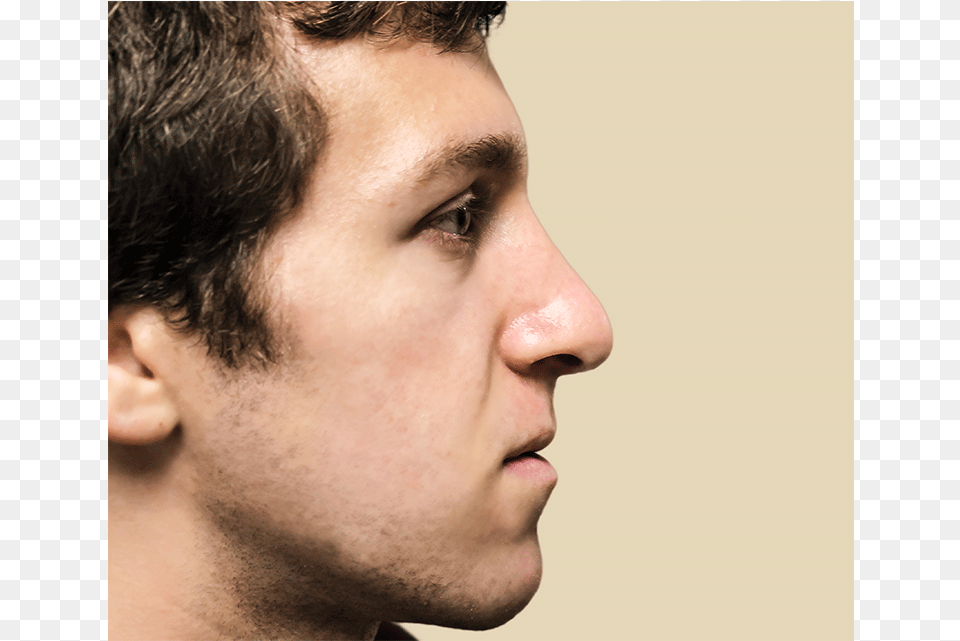 Josh Katz After Edit Surgery, Person, Face, Head, Adult Png Image