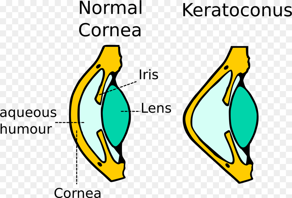 Kerataconus Image Diagram Of Keratoconus, Accessories, Earring, Jewelry, Sea Free Png