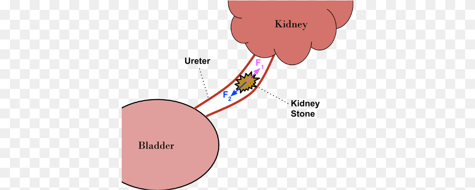 Kidney Stone, Chart, Plot, Person Png