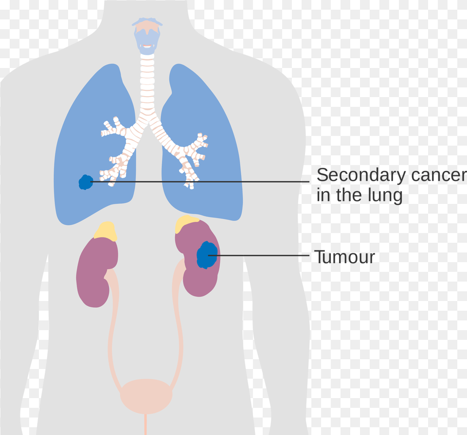 Kidneys Secondary Lung Tumor, Face, Head, Person Free Png Download