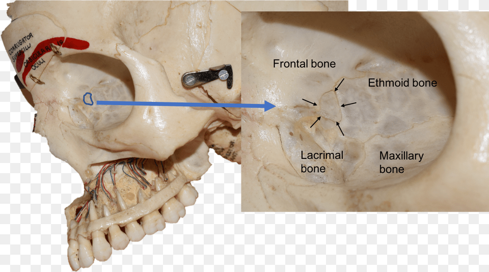 Lacrimal Bone Real Skull, Head, Person, Face, Ct Scan Free Png