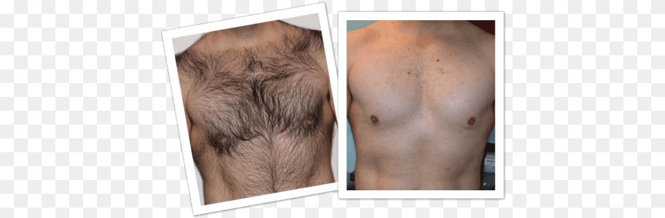 Laser Hair Removal Men Chest Hair Removal Spray, Skin, Person, Adult, Man Free Png Download
