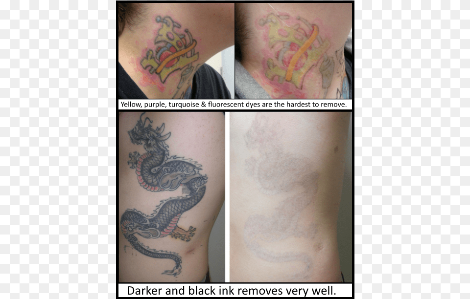 Laser Tattoo Removal In Milton Keynes Tattoo, Person, Skin Png