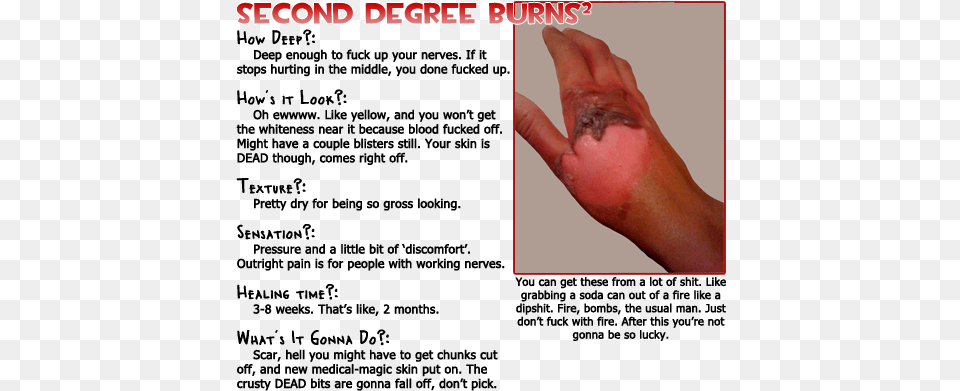 Later On It Still Has A Sort Of Tougher Texture And Second Degree Burn Chart, Body Part, Finger, Hand, Injury Free Transparent Png