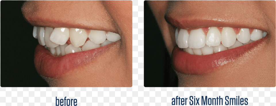 Leave A Reply Cancel Reply Braces 6 Months Progress, Body Part, Mouth, Person, Teeth Png Image