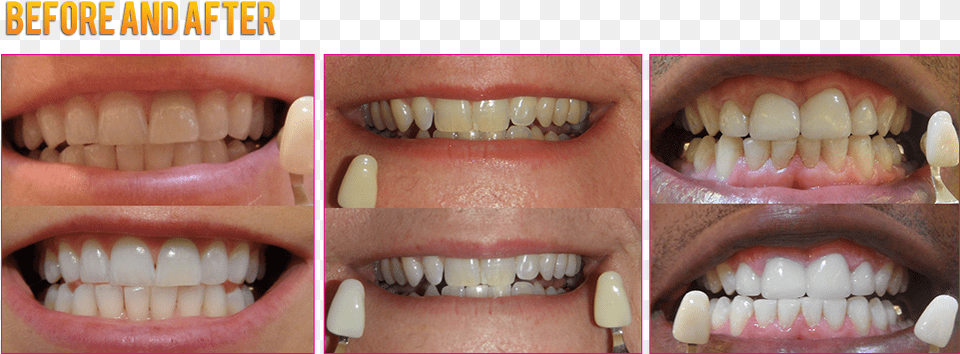 Led Teeth Whitening Coupons Led Teeth Whitening Before Colorfulness, Body Part, Mouth, Person, Baby Free Png