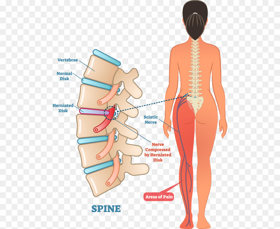 Left Side Sciatic Nerve Pain, Adult, Female, Person, Woman Free Png Download