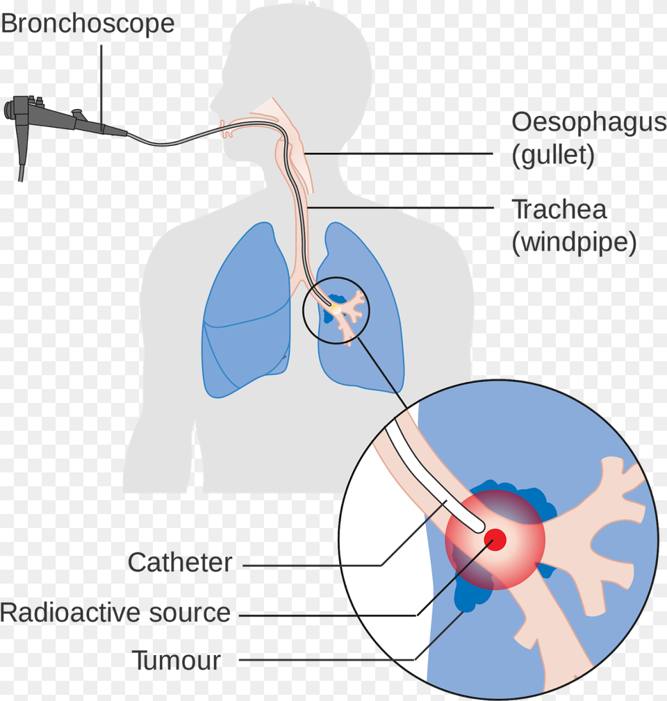Lung Cancer Is The Leading Cause Of Death Due To Cancer Lung Cancer Radiation Therapy Diagram, Architecture, Building, Hospital, Person Free Transparent Png