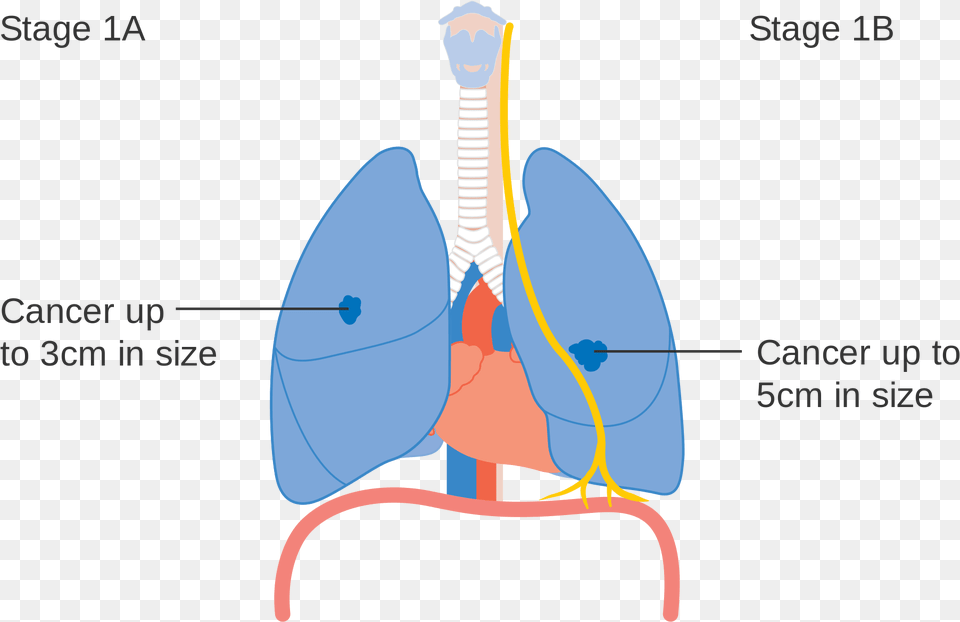 Lung Cancer Stages Diagram Png Image