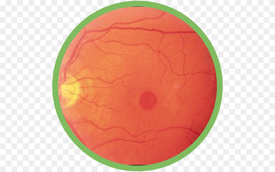 Macular Hole, Disk Free Png
