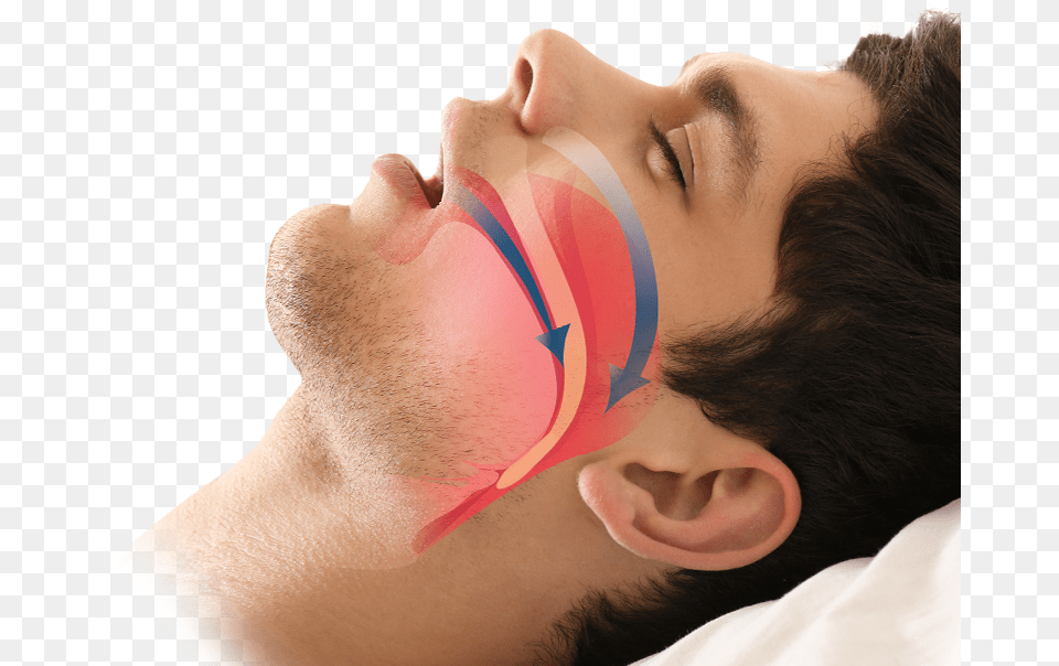 Man Sleeping Surgery Sleep Apnea, Adult, Face, Head, Male Free Png