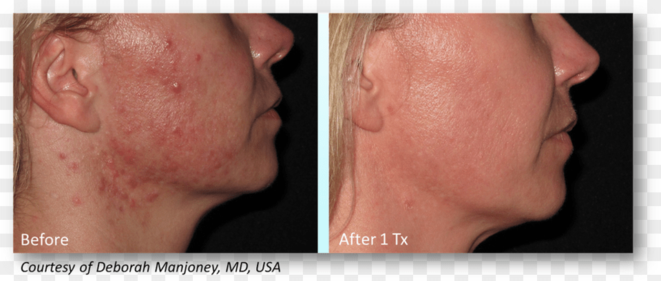 Manjoney Infini Acne Scars Before And After, Body Part, Face, Head, Neck Free Png Download