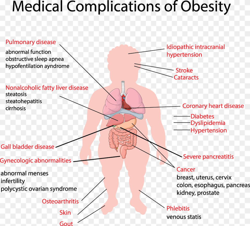 Medical Complications Obesity Medical Obesity Complication, Chart, Plot, Baby, Person Png Image
