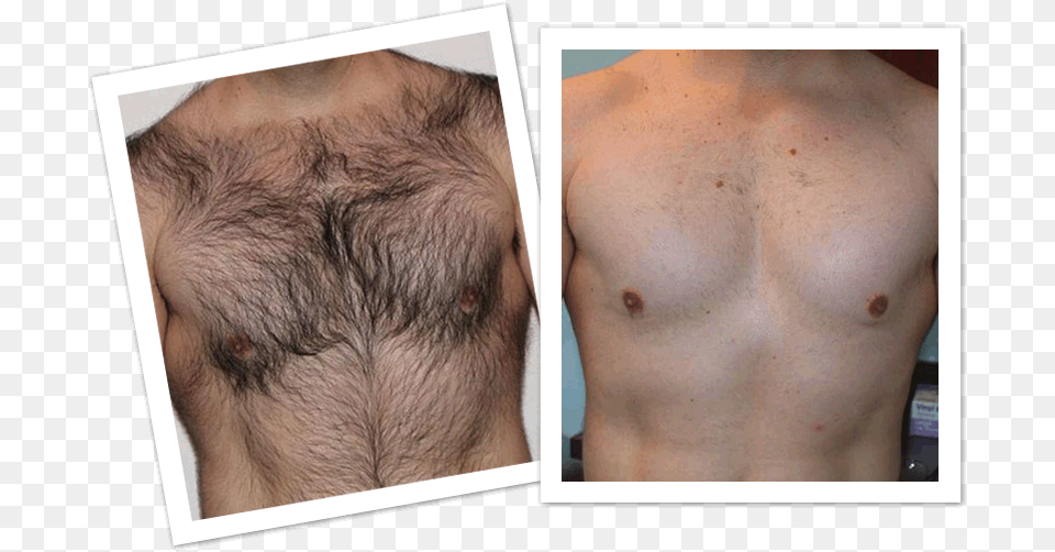 Mens Laser Hair Removal Before And After, Skin, Person, Adult, Male Free Png Download