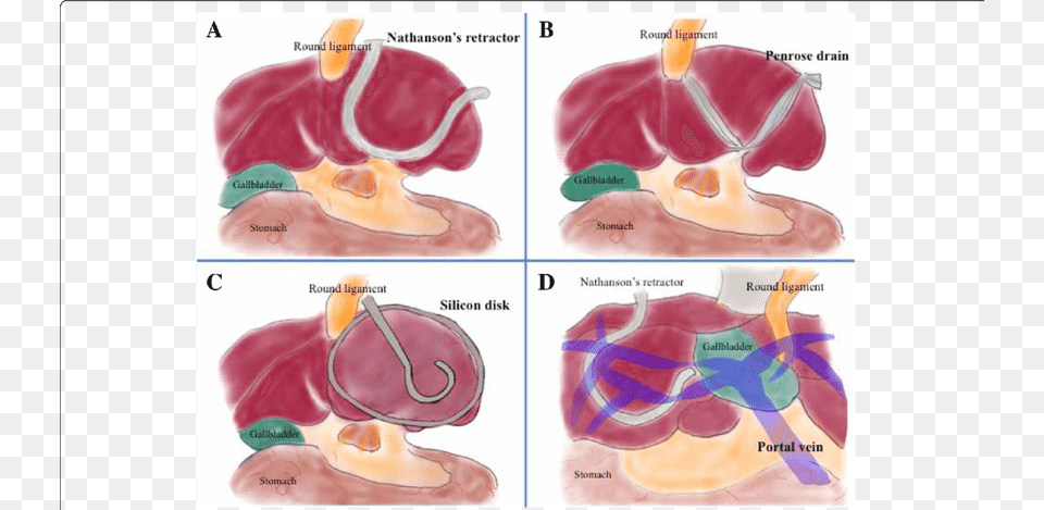 Methods Of Retracting The Left Liver Lobe, Body Part, Face, Head, Neck Free Png