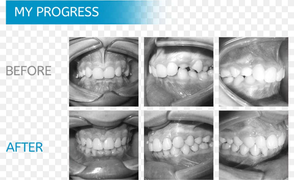 Midwest Orthodontics Chicago Teeth Xray Before And After Braces, Body Part, Mouth, Person, Baby Free Png