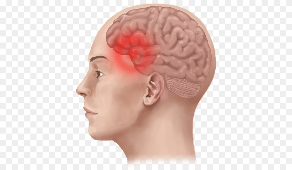 Migraine Pain In Head, Adult, Body Part, Face, Female Free Png