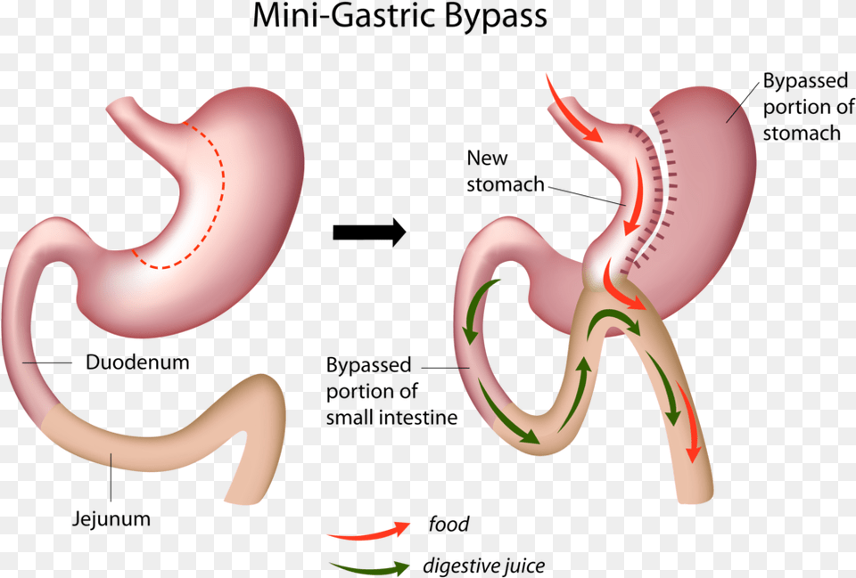 Mini Gastric Bypass, Body Part, Stomach, Smoke Pipe Png Image