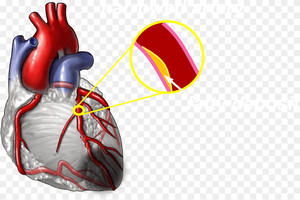 Moderate Blocked Heart Arteries, Baby, Person Free Png Download