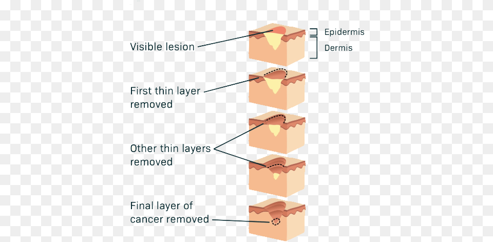 Mohs Surgery Skin Cancer, Drawer, Furniture, Box, Wood Png Image