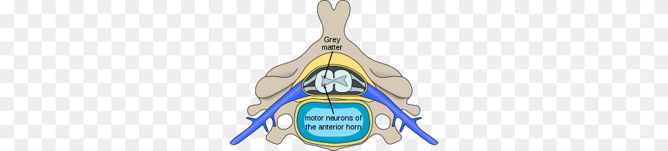 Motor Neuron Disease, Baby, Person, Ct Scan Png Image