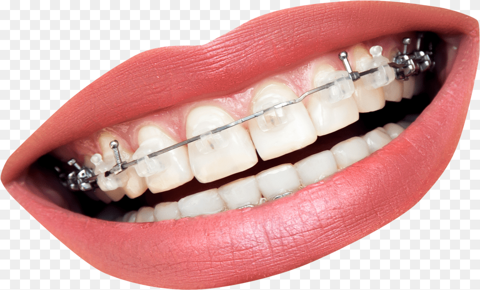 Mouth With Braces, Body Part, Person, Teeth, Face Png Image