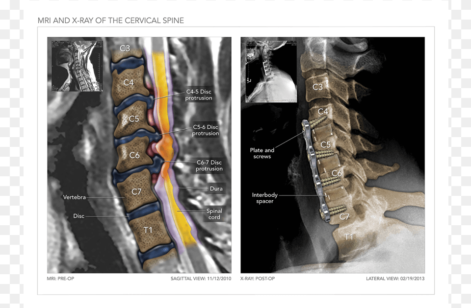 Mri And X Ray Of The Cervical Spine Medical Imaging, Ct Scan, Adult, Bride, Female Free Png Download