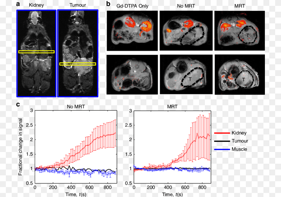 Mrt Of Magnetic Cells Into Tumours Does Not Affect, Ct Scan, Adult, Bride, Face Free Transparent Png