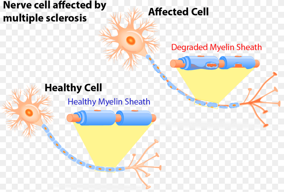 Multiple Sclerosis Nerve Cells, Alcohol, Beverage, Cocktail Free Png Download