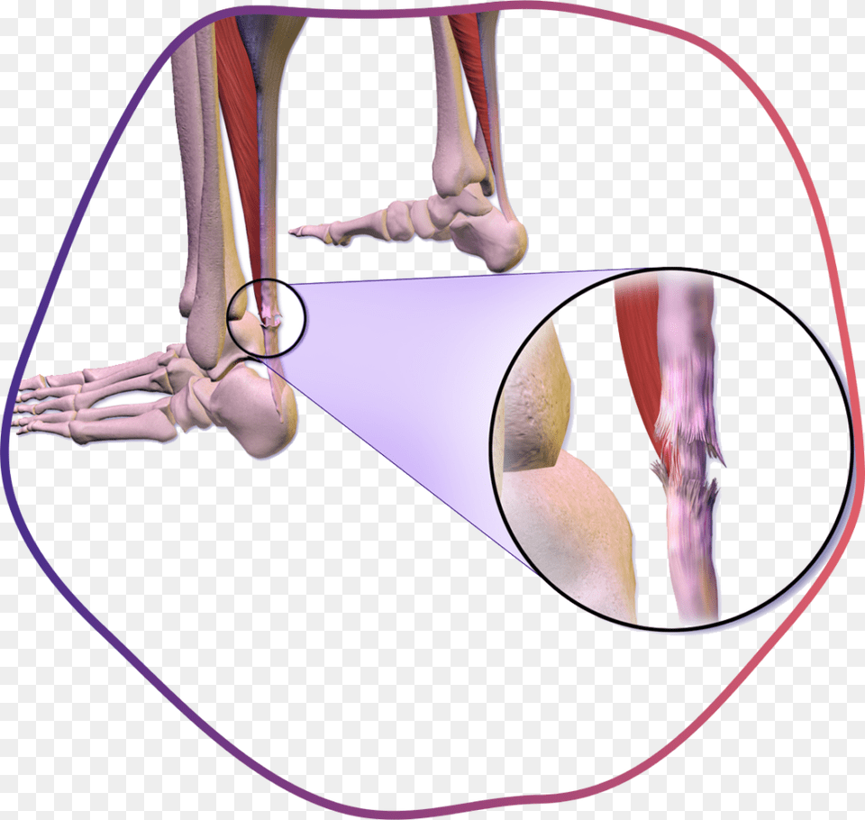 Muscle Tear Tendon Calcification Achilles Cause, Adult, Female, Person, Woman Free Png