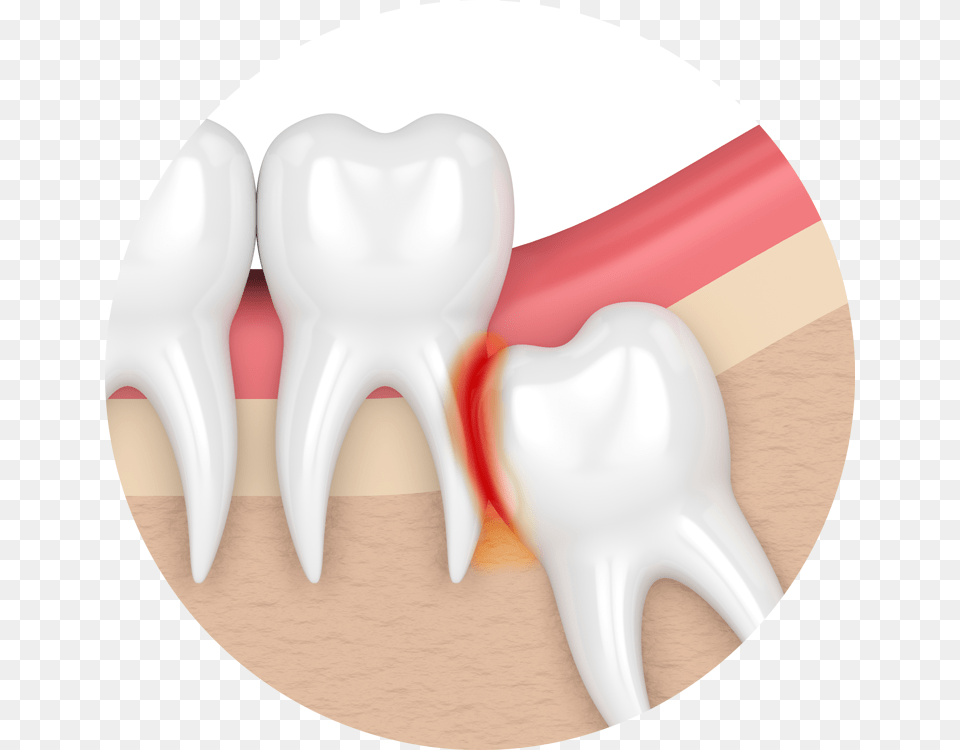 My Teeth Are Becoming Transparent Impaction Teeth Impacted Wisdom Tooth, Body Part, Mouth, Person, Head Free Png