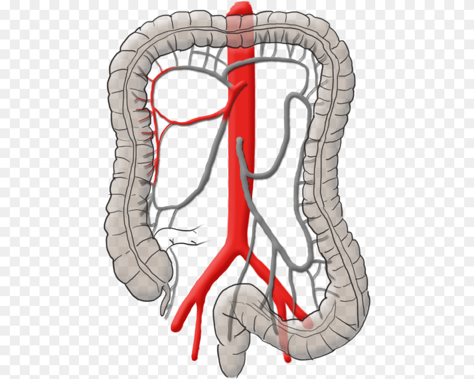 Mysurgery Carcinoma Right Colic Operation Darmkrebs Png Image