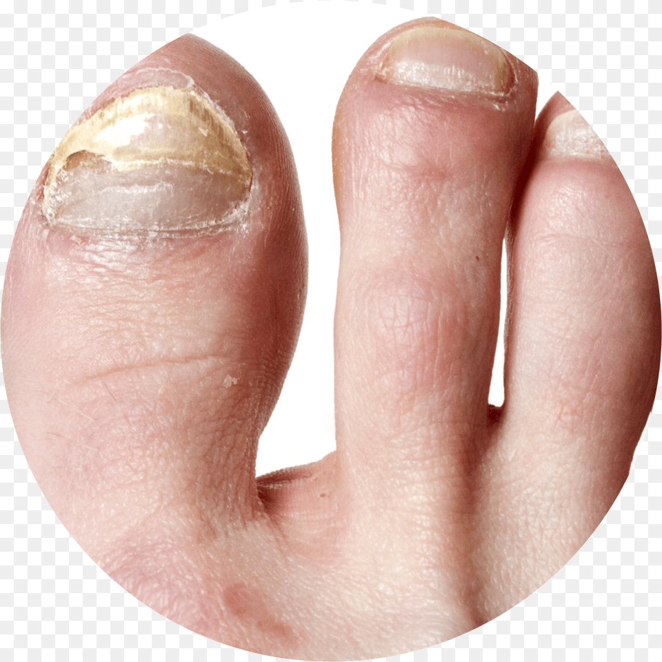 Nail Infection Circle Gribok Na Nogtyah Nog, Body Part, Person, Toe, Baby Free Png Download