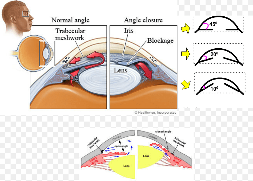 Narrow Angles Occur In Smaller Eyes Where There Is Open Angle Glaucoma Vs Normal, Book, Publication, Comics, Adult Free Png