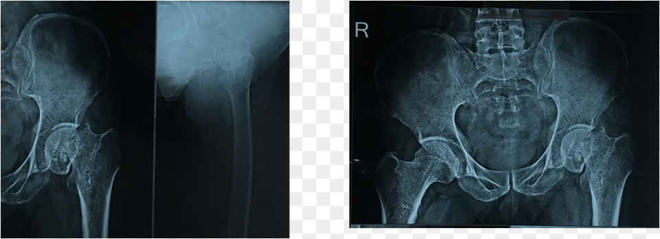 Neck Of Femur Fracture Secondary To Bone Infarcts Of Femur, Adult, Bride, Ct Scan, Woman Free Png Download