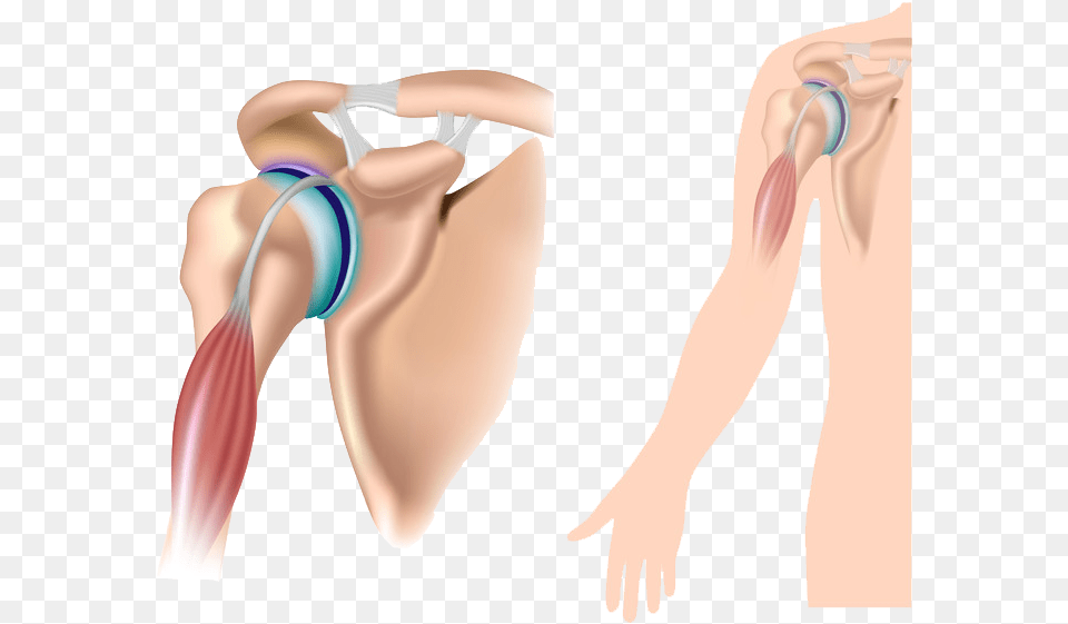 Non Surgical Options Separated Shoulder, Adult, Female, Person, Woman Free Png