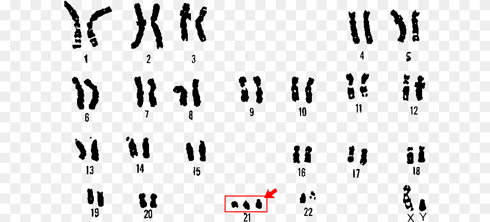 Nondisjunction Down Syndrome Karyotype Png