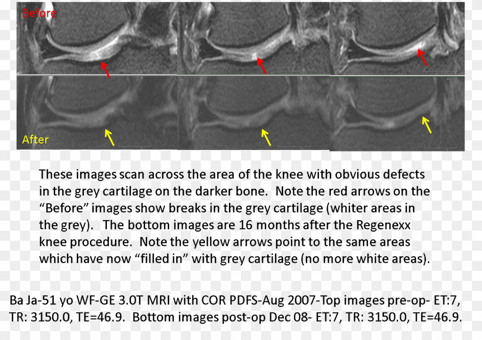Note The Red Arrows Point To Breaks In The Cartilage Knee, Ct Scan Free Png