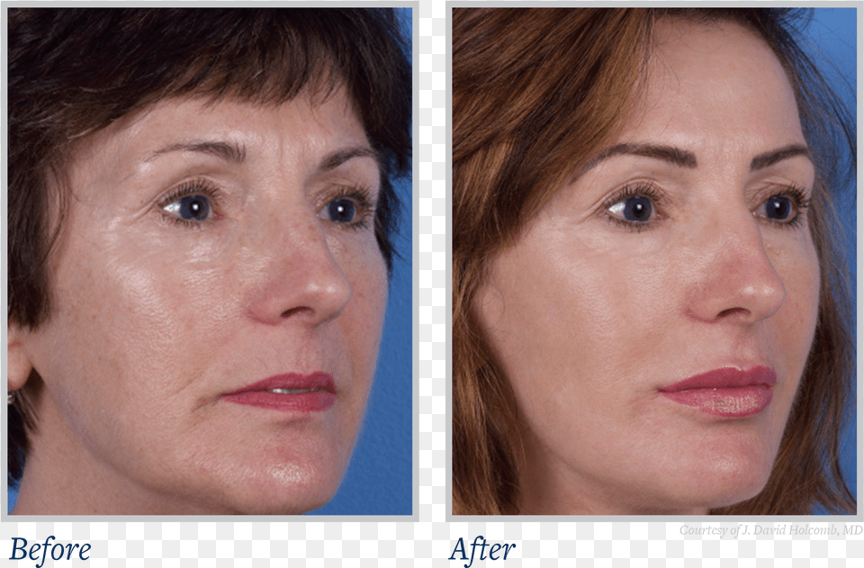 Now Available To The General Public Skin Texture Before And After Free Png Download