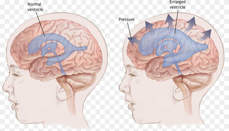 Null Hydrocephalus Brain, Head, Person, Body Part, Face Png