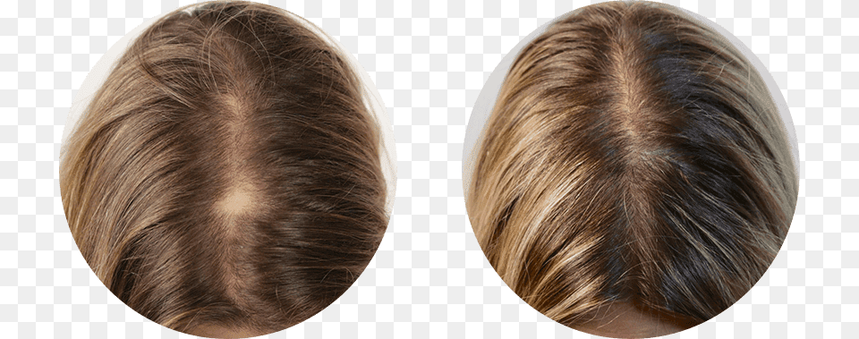 Nutrafol Before After, Photography, Child, Female, Girl Png