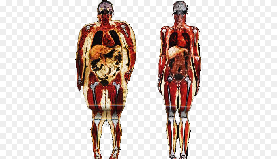 Obesity Human Body Adipose Tissue Anatomy Connective Fat Person Vs Skinny Person, Adult, Bride, Female, Wedding Free Png